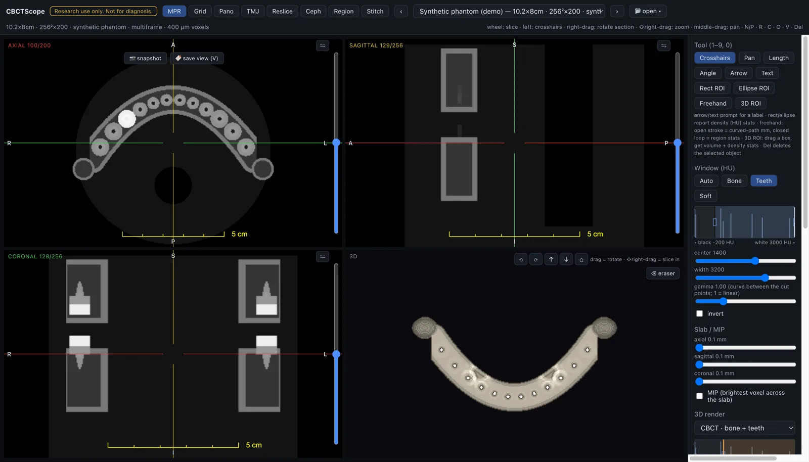 CBCTScope MPR mode: axial, sagittal and coronal panes with live crosshairs, a 3D render of the arch, HU window presets with histogram, slab and MIP controls