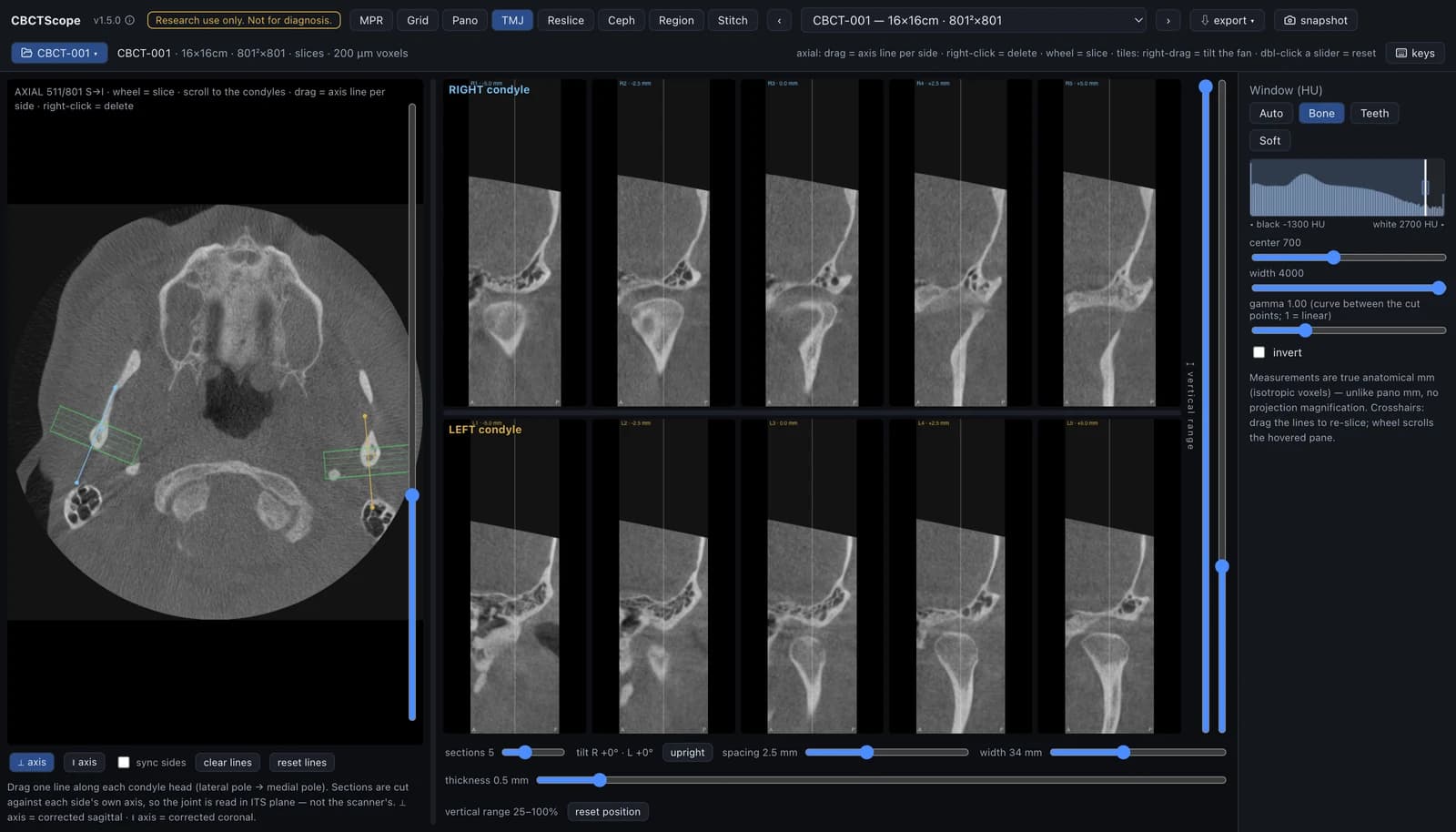 CBCTScope TMJ mode: both condyles in axis-corrected sagittal sections, five per side, the axis line drawn per condyle on the axial scout
